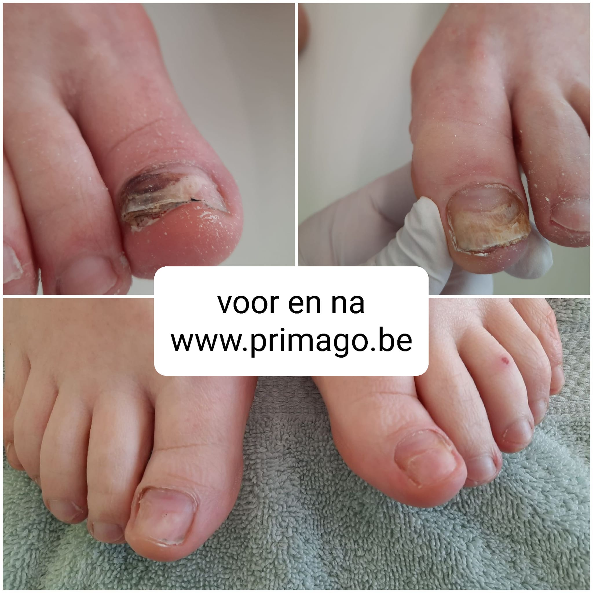 pedicuristen Sint-Gillis-bij-Dendermonde | Primago